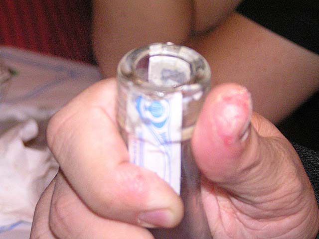 Botella y dedo con herida